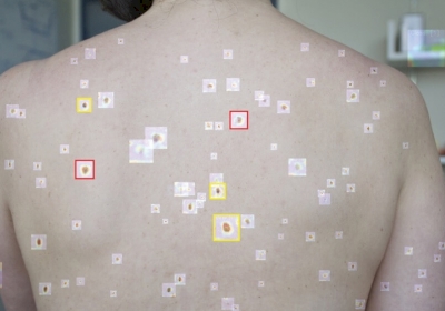 AI Detects Melanoma